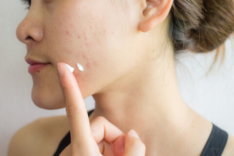 DC-area dermatologist says ‘do not panic’ if you used acne products contaminated with benzene